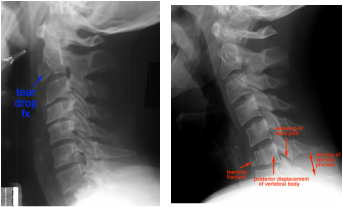 Fractures - CERVICAL SPINE PAIN